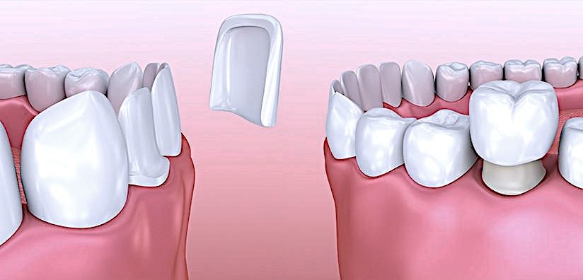 kırık diş tedavisi nasıl yapılır