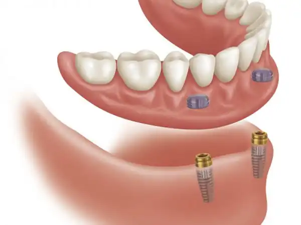 Konya implant fiyatları 2025