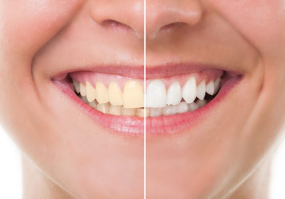 Diş Taşı Temizliği | Diş Beyazlatma Konya